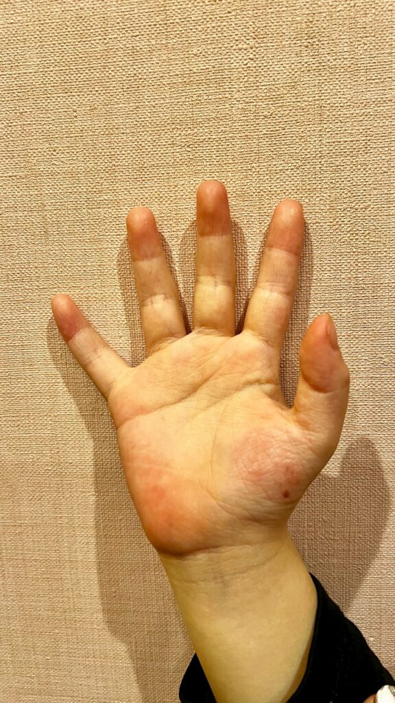 子どものアトピーが良くなってきた手