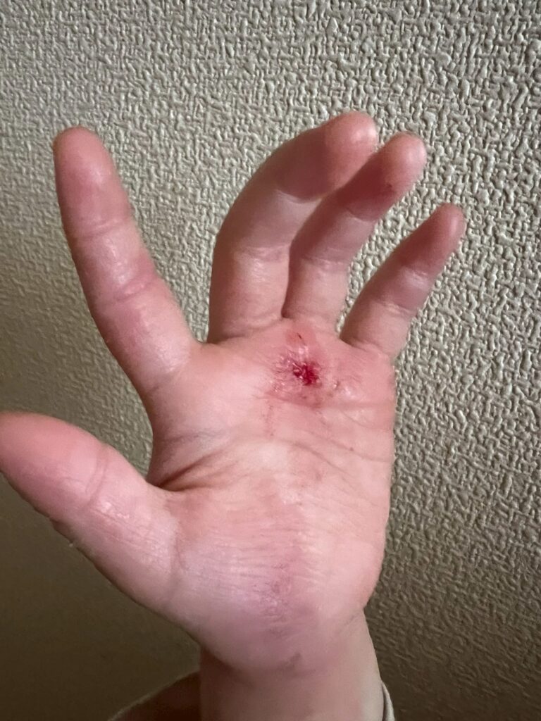 アトピーがひどかった頃の子供の手