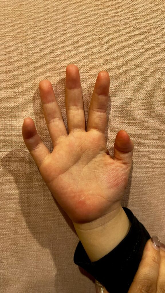 子どものアトピーの手