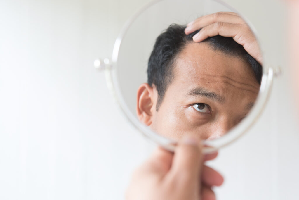 男性の薄毛